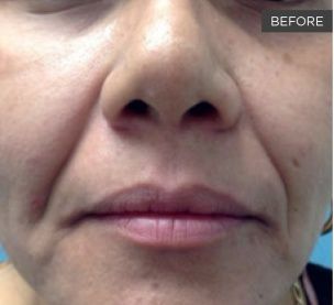 Before Man 's Face With Blue Eyes — Saint Johns, FL — Live Without Lines Med Spa