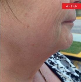 After Man 's Face With Blue Eyes — Saint Johns, FL — Live Without Lines Med Spa