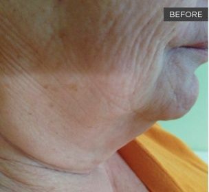 Before Man 's Face With Blue Eyes — Saint Johns, FL — Live Without Lines Med Spa