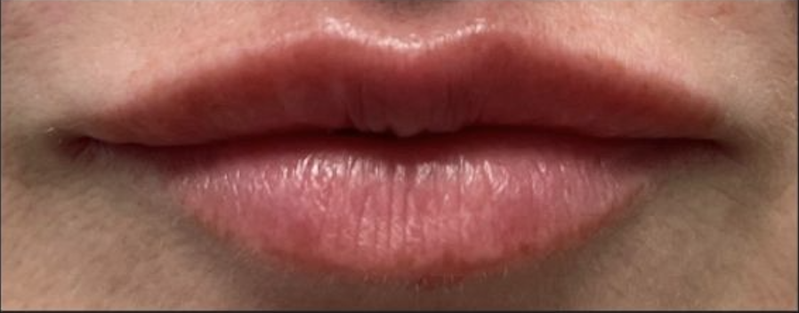 After Lip Filler — Saint Johns, FL — Live Without Lines Med Spa