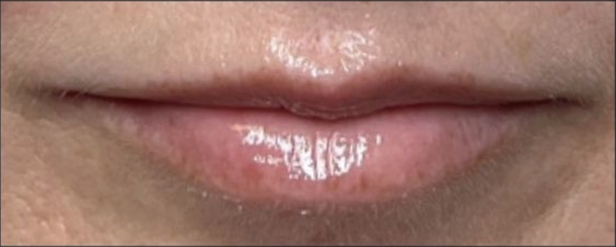 Before Lip Filler  — Saint Johns, FL — Live Without Lines Med Spa