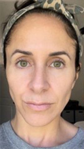Before Woman Without Makeup — Saint Johns, FL — Live Without Lines Med Spa