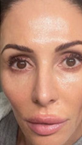 After Woman 's Face With No Makeup on — Saint Johns, FL — Live Without Lines Med Spa