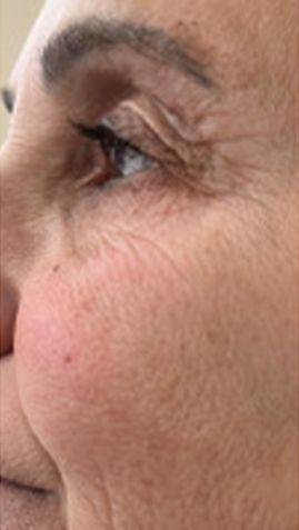 Before Woman 's Face With Wrinkles — Saint Johns, FL — Live Without Lines Med Spa
