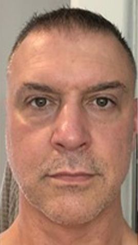 After Man 's Face With a Beard — Saint Johns, FL — Live Without Lines Med Spa