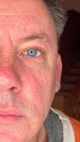 Before Man 's Face With Blue Eyes — Saint Johns, FL — Live Without Lines Med Spa