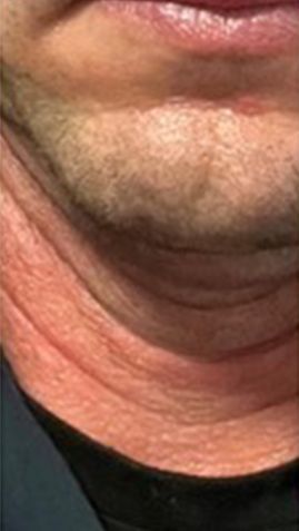 Before Man 's Neck With Wrinkles — Saint Johns, FL — Live Without Lines Med Spa