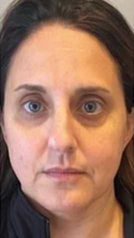 Before Woman 's Face With a Serious Look — Saint Johns, FL — Live Without Lines Med Spa