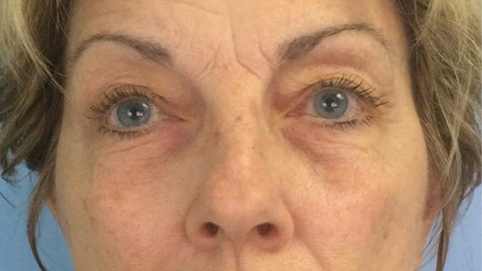 After Celluma Led Light Therapy — Saint Johns, FL — Live Without Lines Med Spa