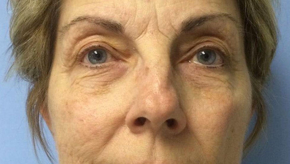 Before Celluma Led Light Therapy — Saint Johns, FL — Live Without Lines Med Spa