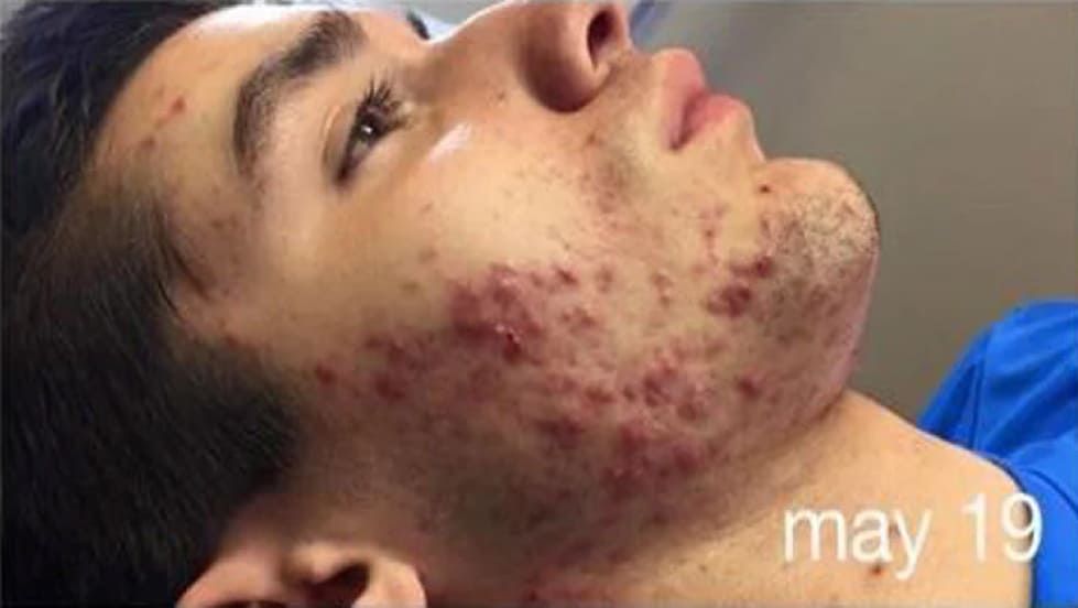 Before Acne Treatment — Saint Johns, FL — Live Without Lines Med Spa