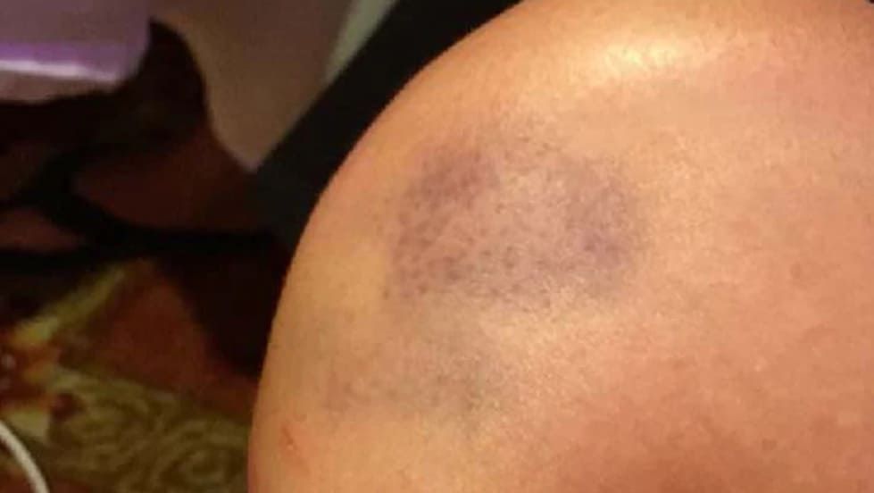 After Bruising — Saint Johns, FL — Live Without Lines Med Spa