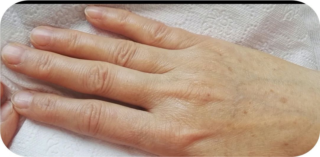 After Oxygeneo Treatment — Saint Johns, FL — Live Without Lines Med Spa