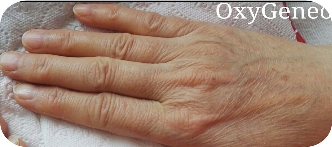 Before Oxygeneo Treatment — Saint Johns, FL — Live Without Lines Med Spa