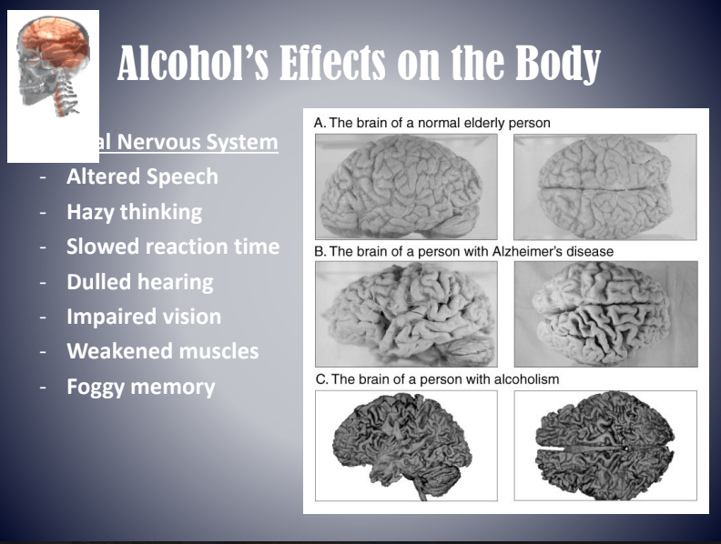 Infographic on alcohol’s effects: nervous system symptoms and brain scans comparing normal, Alzheimer’s, and alcoholic brains