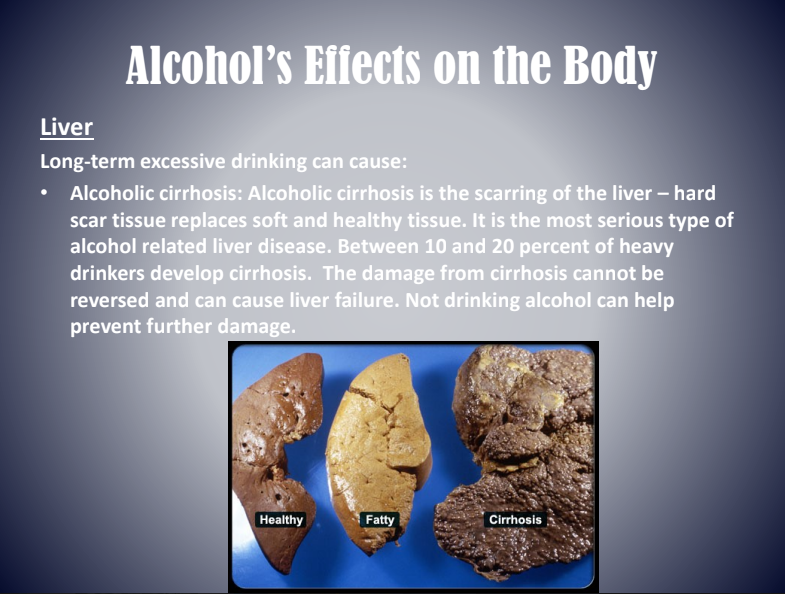 Infographic on alcohol’s effects on the liver, showing healthy, fatty, fibrotic, and cirrhotic liver stages.