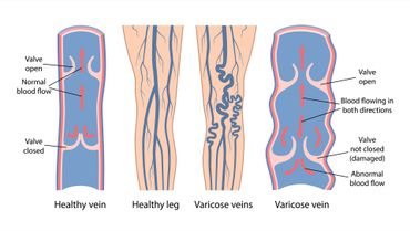 A diagram of healthy veins and varicose veins