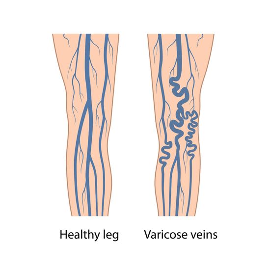 A diagram of a healthy leg and varicose veins
