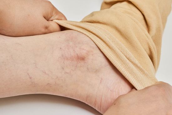 A close up of a person 's leg with varicose veins