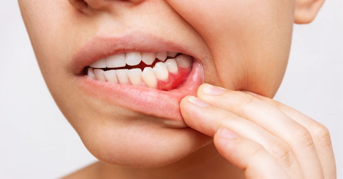 Image related to Symptoms of Gum Disease in Children