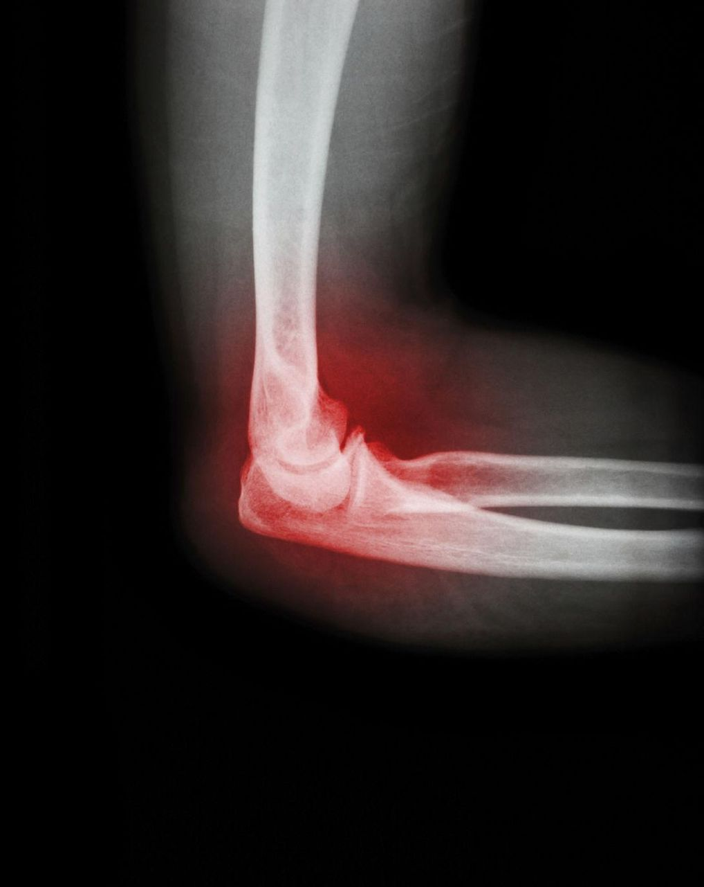 Elbow Arthritis