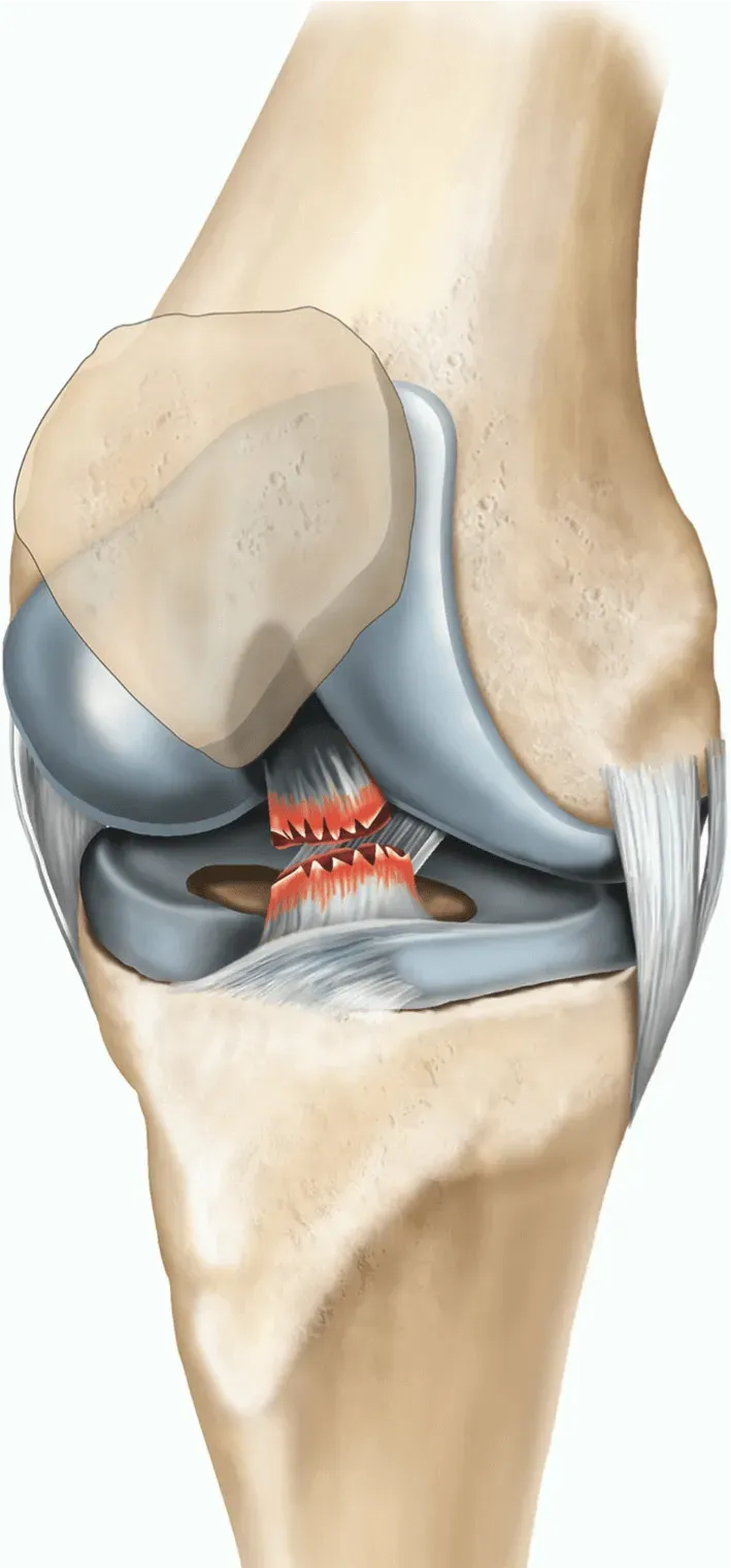 Knee Joint Replacement