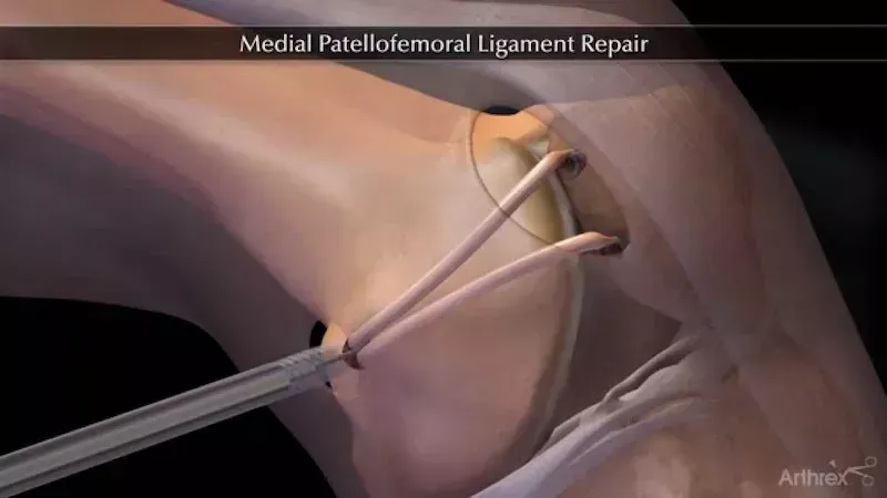 Surgical illustration of MPFL repair with instruments suturing the knee joint
