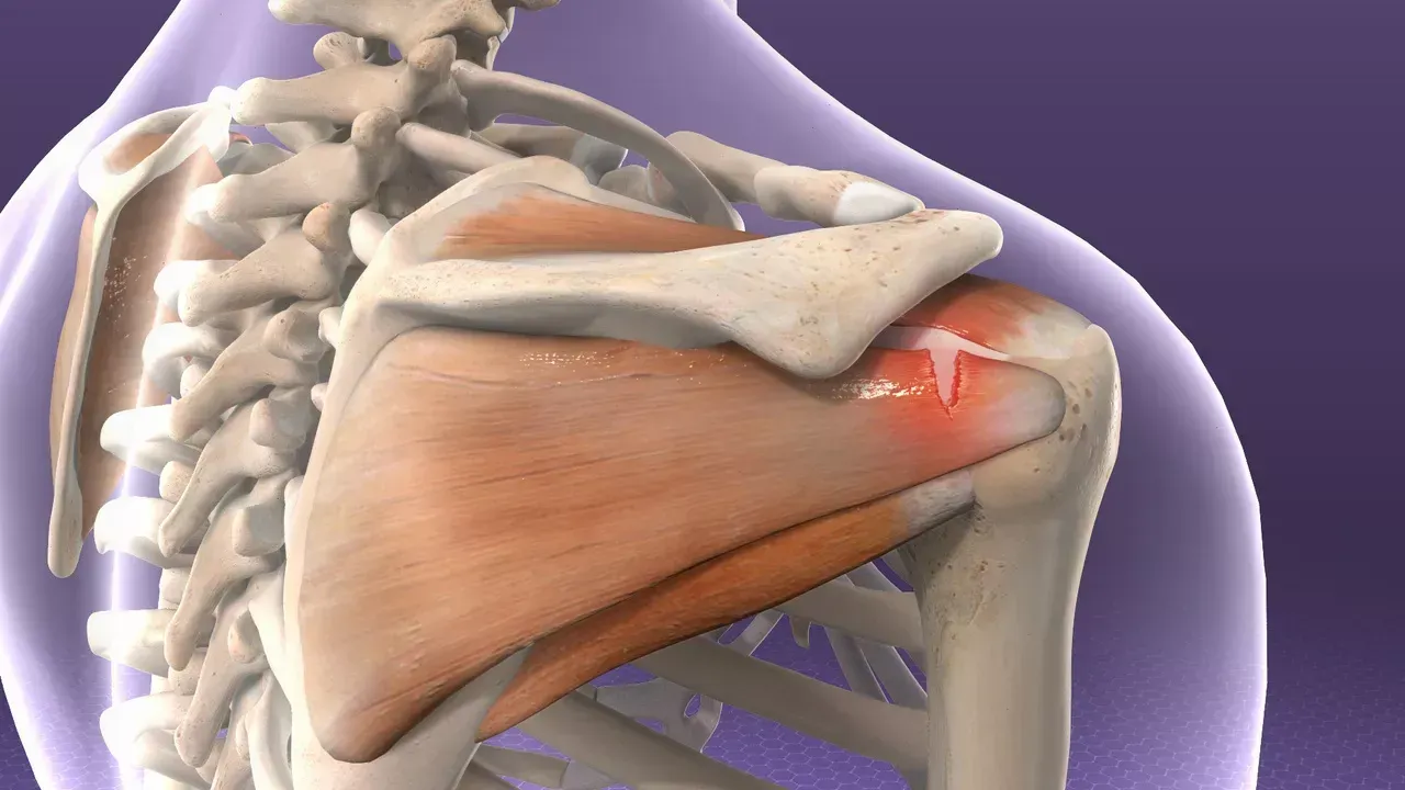 Human shoulder anatomy showing the shoulder blade and rotator cuff with a red pain highlight