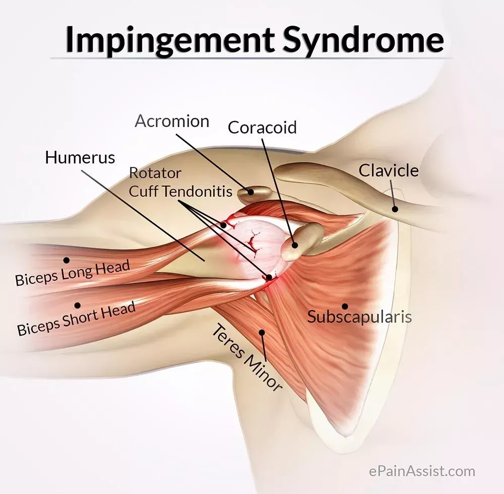 Shoulder Impingement