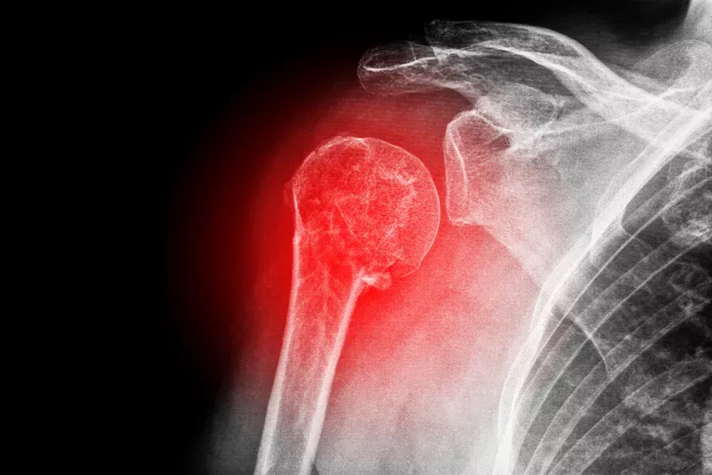 X-ray of a shoulder with the upper arm and joint highlighted in red