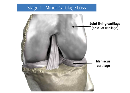 Knee joint diagram labeled “Stage 1 - Minor Cartilage Loss,” showing articular cartilage and meniscus cartilage.