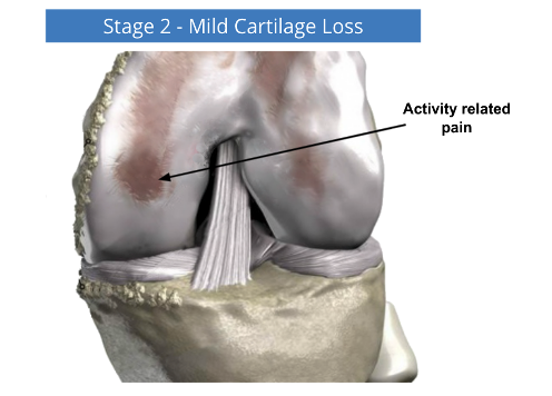 Knee joint diagram labeled “Stage 2 - Mild Cartilage Loss” with arrow showing activity related pain