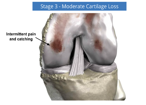 Knee joint diagram labeled “Stage 3 - Moderate Cartilage Loss” with arrow to pain and catching area