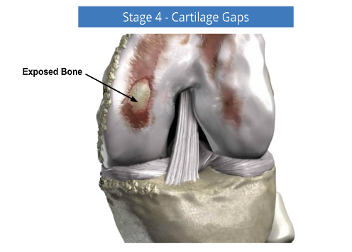 Stage 4 cartilage gap in knee joint, with exposed bone and torn ligament fibers.