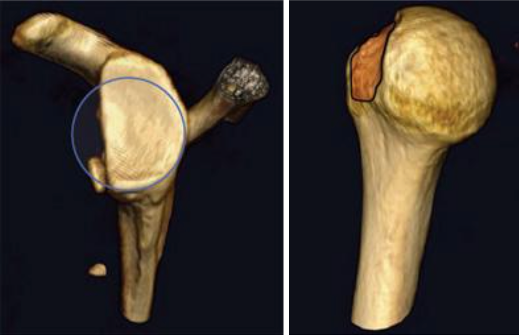 Split-view medical image of a shoulder joint with a highlighted fracture area on the humeral head