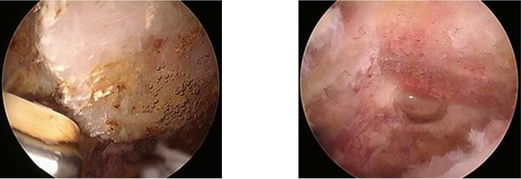 Shoulder Impingement