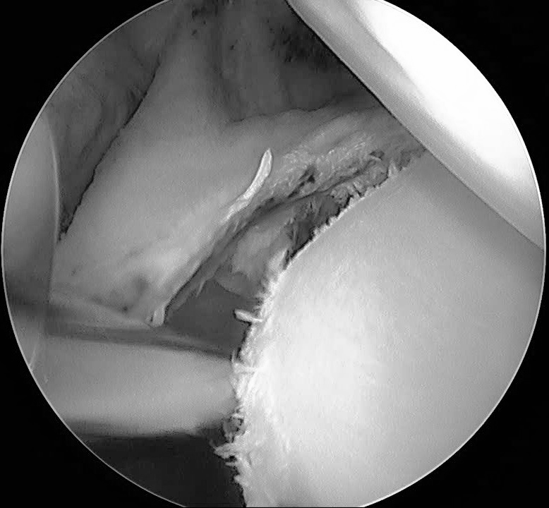 Close-up of a grayscale surgical view showing instruments inside a joint or cavity.