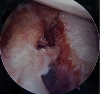 Circular endoscopic view of inflamed tissue with a central opening and reddish fluid