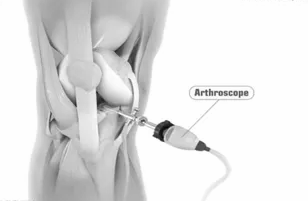 Knee joint model with an arthroscope inserted through a small side incision.