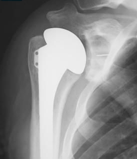 Anatomical shoulder replacements for osteoarthritis using long stems