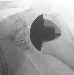 Anatomical shoulder replacements for osteoarthritis using short stems