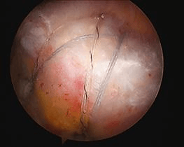 A degenerate, frayed, dislocated or inflamed long head of bicep tendonitis is usually removed from the joint. 