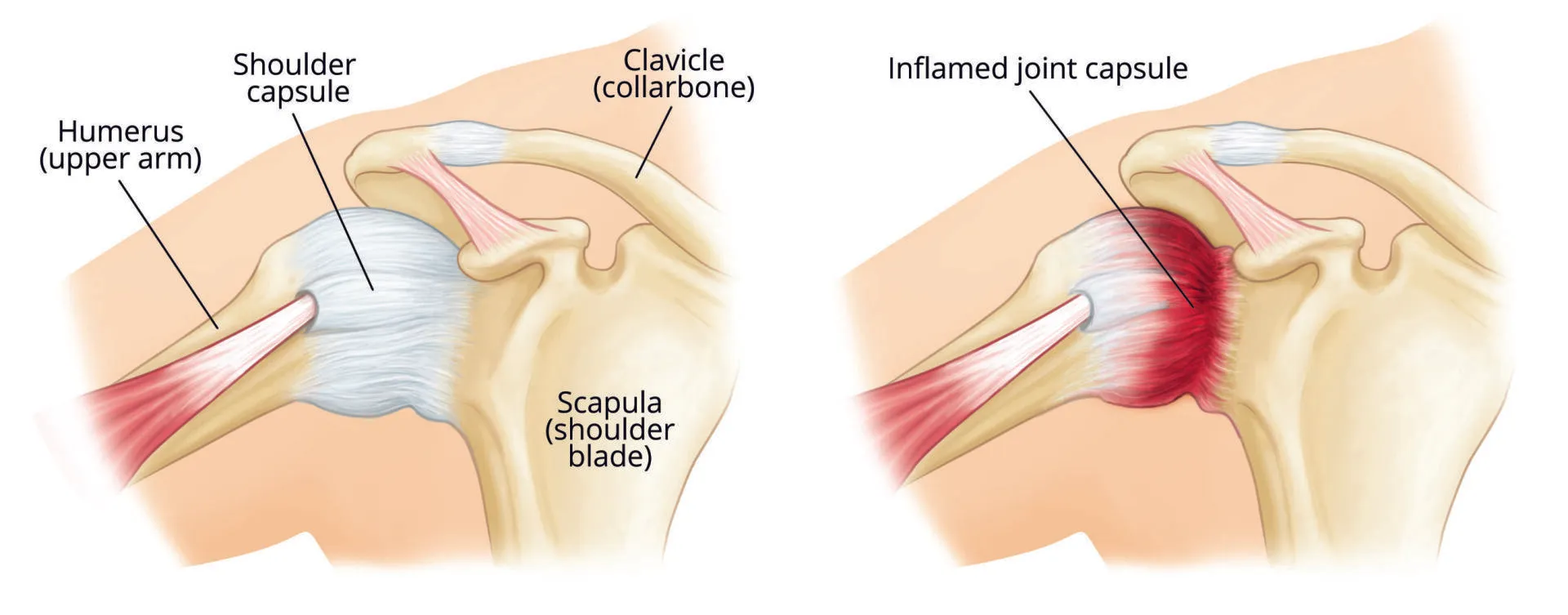 Shoulder anatomy diagram showing normal joint and inflamed rotator cuff bursa with pain area highlighted