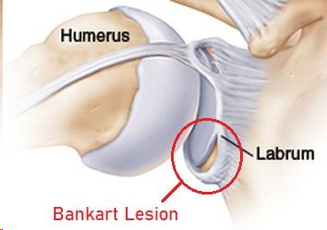 Shoulder anatomy diagram highlighting a Bankart lesion at the labrum near the humerus with a red circle