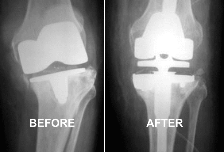 Knee X-ray before and after total knee replacement, labeled “BEFORE” and “AFTER.”