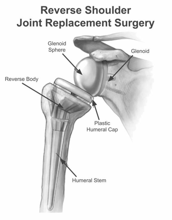 Diagram of reverse shoulder joint replacement surgery with labeled implant parts and bones
