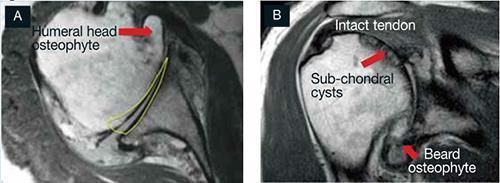 MRI of a shoulder with arrows highlighting humeral head osteophyte, intact tendon, subchondral cysts, and beard osteophyte