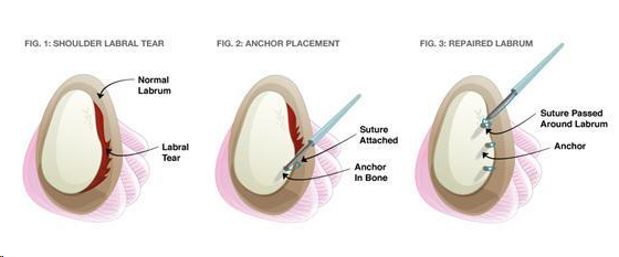 Illustration of three nasal septum repair stages with labeled anatomical cross-sections and arrows
