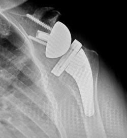 X-ray of a shoulder with a metal joint replacement implant and screws.