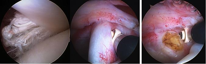 A degenerate, frayed, dislocated or inflamed long head of bicep tendonitis is usually removed from the joint. 